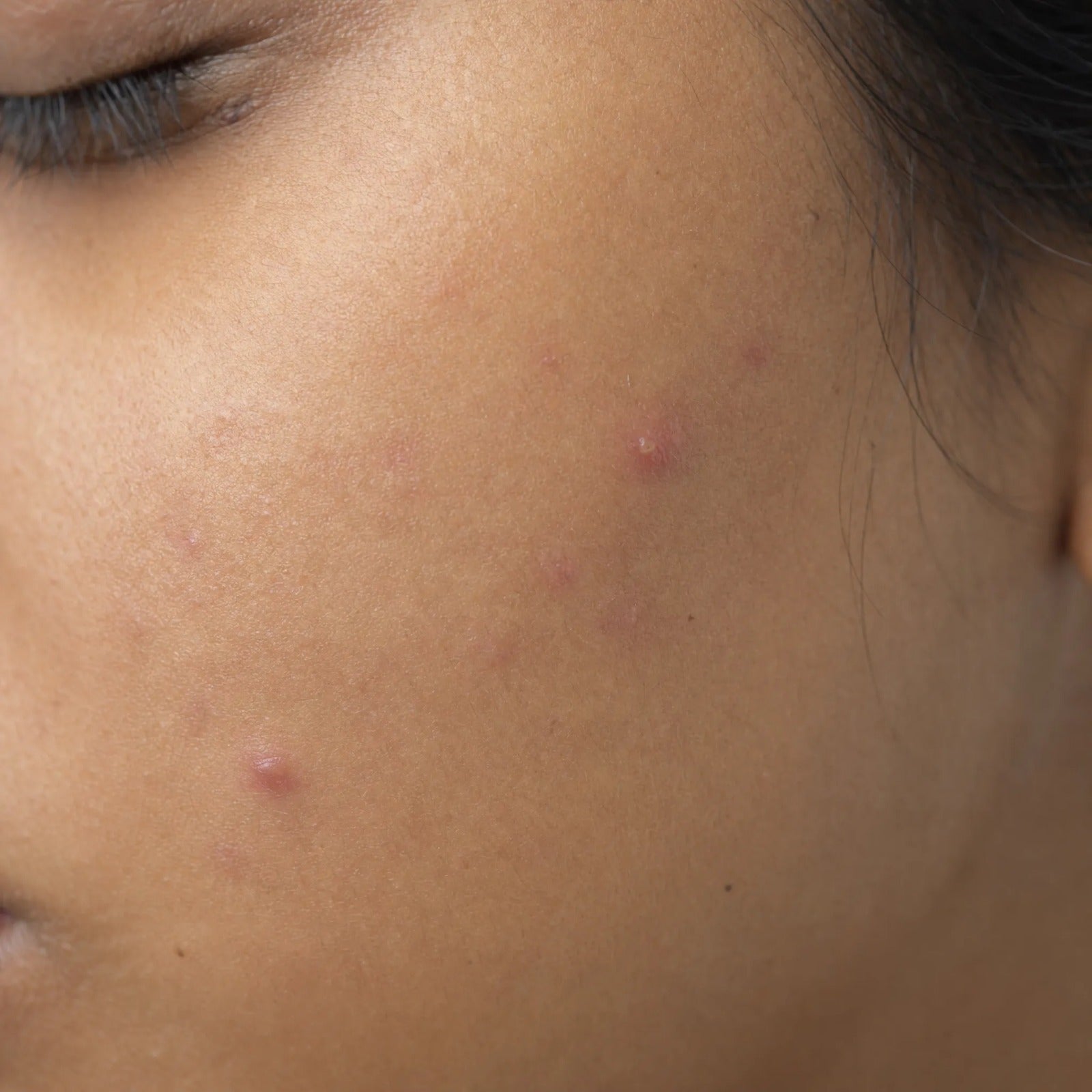 Pimples